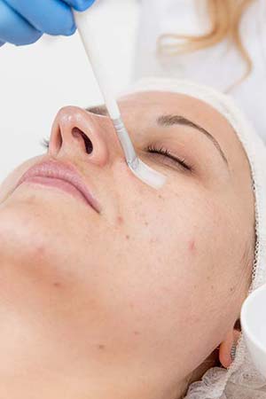 Less spots with chemical peels