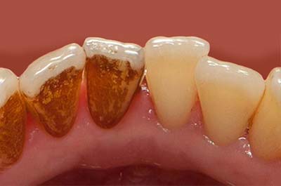 North Street Dental services - Air Flow polishing