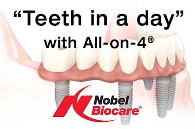 Denture Clinic services - All-on-4 teeth in a day