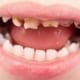 Children’s rotten teeth cost hospitals £35m per year