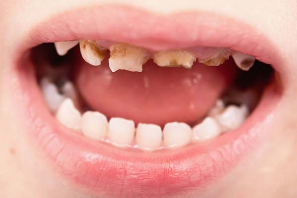 Children’s rotten teeth cost hospitals £35m per year