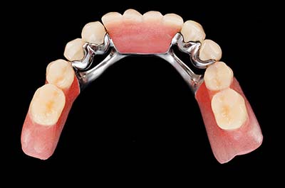 Denture Clinic services - chrome dentures
