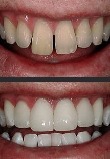 Componeer veneers before and after 1