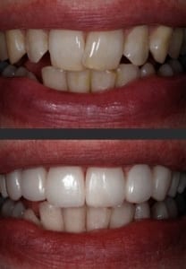 Componeer veneers before and after 2