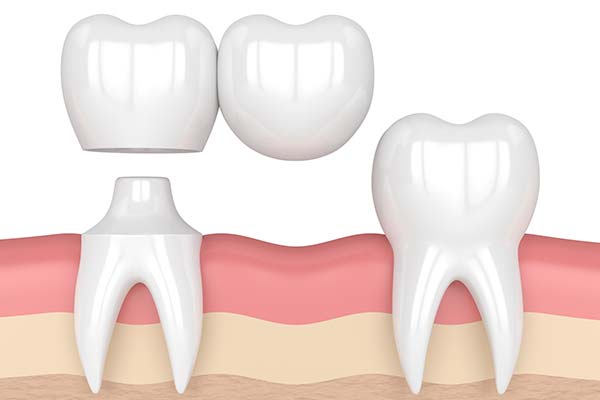 Dental bridges - Cantilever bridges