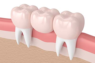 North Street Dental services - dental bridges