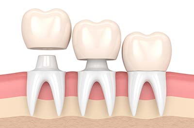 North street Dental services - dental crowns