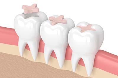 North Street Dental services - fillings