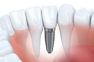 North Street Dental services - dental implants