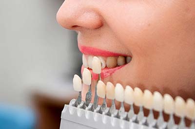 North Street Dental services - dental veneers