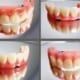 Dentures – bright and shining smiles