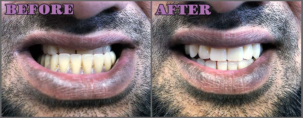 Dentures in a day before and after