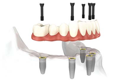 Implant retained lower crown of teeth on multiple fixings