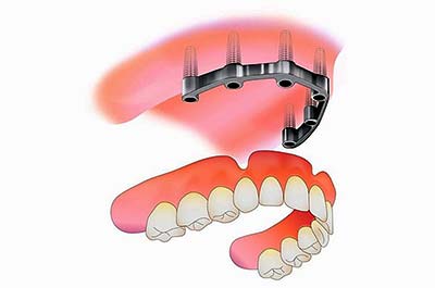 Denture Clinic services - implant retained dentures