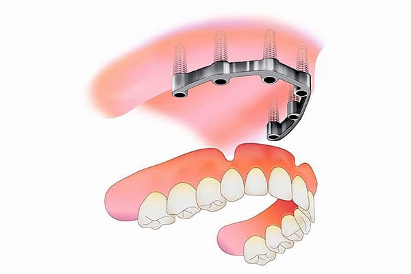 implant retained dentures