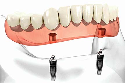 Implant retained lower overdenture on two fixings