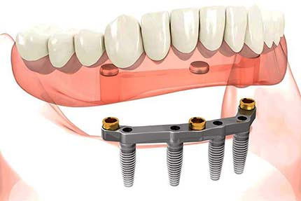 Implant retained lower overdenture on All-on-4 bar