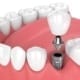 Implant teeth procedure