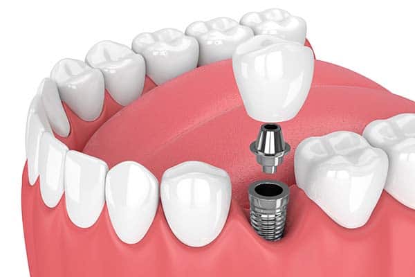 Implant teeth procedure