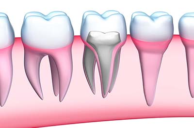 North Street Dental services root fillings