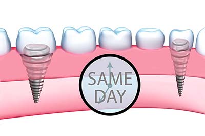 Denture Clinic services - same day teeth