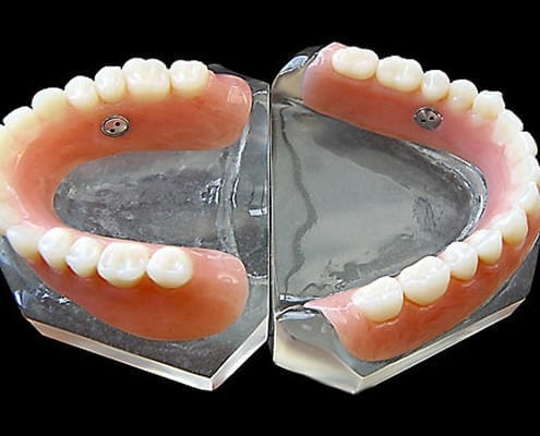 suction dentures - Ultra suction system