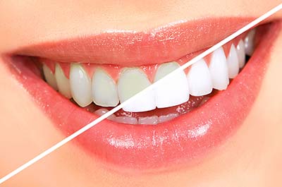 North Street Dental services - teeth whitening