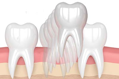 North Street Dental services - tooth extractions