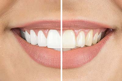 Rejuvenate services - tooth whitening