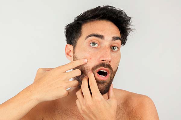 treatments for men - acne