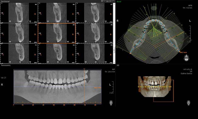 Vatech 3D dental scan 02