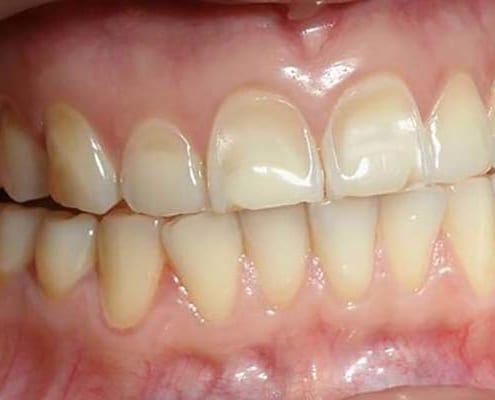 What is dental erosion?