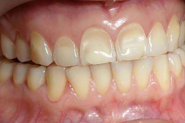 What is dental erosion?