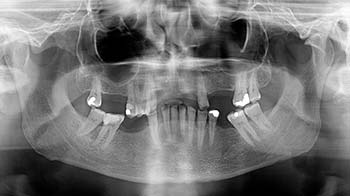dental X-ray