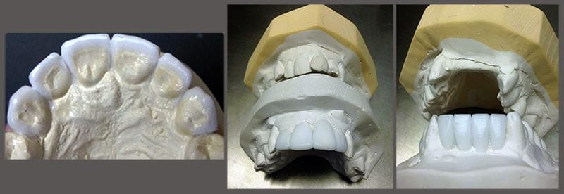 Missing teeth – a modern option - wax-up