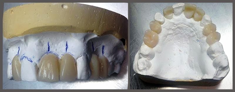 Missing teeth – a modern option - wax mock-up