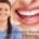 Effective interdental cleaning