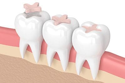 Explore our Composite Bonding Treatments
