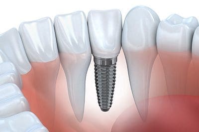 dental-implants-services Denture Clinic services - denture relines