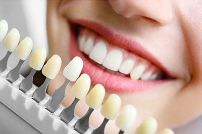 dental-veneers-services North Street Dental services - fillings