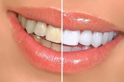 teeth-whitening-services North Street Dental services - fillings