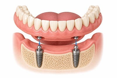 implant-retained-dentures-services-4 Explore our Implant retained dentures treatment